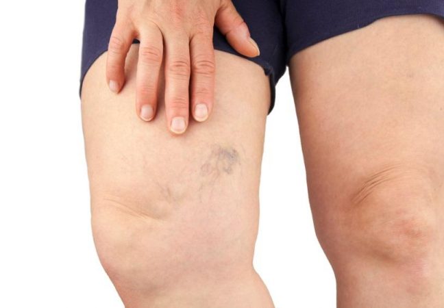 como tratar las varices con remedios caseros 17189 orig Merca2.es