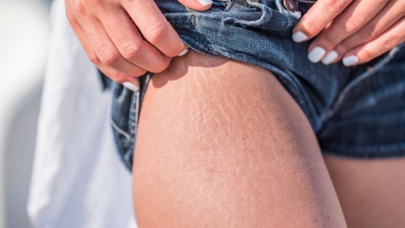 Trucos caseros para que no te salgan estrías 28 Merca2.es estrías