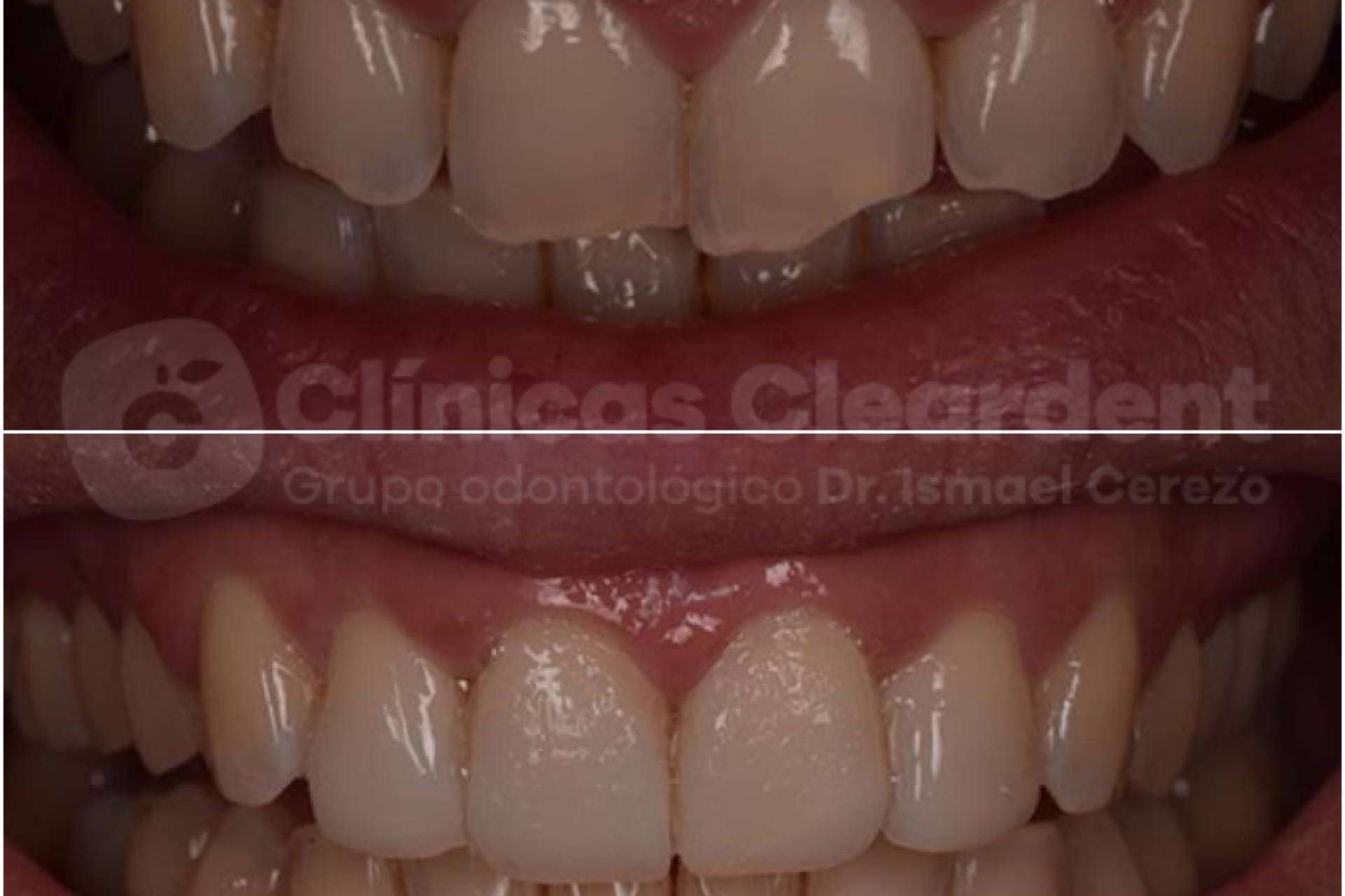 Las opciones de carillas dentales que ofrece Cleardent