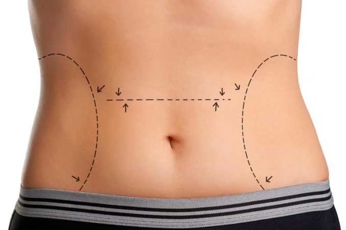 abdominoplastia Merca2.es