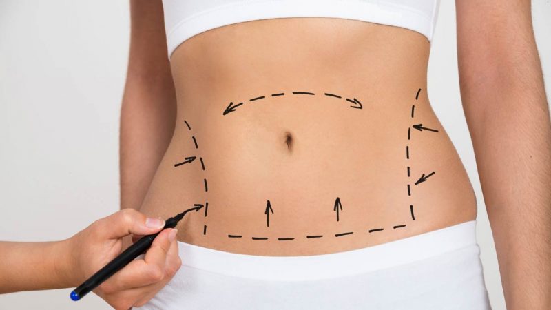 adriana cely abdominoplastia 2 Merca2.es