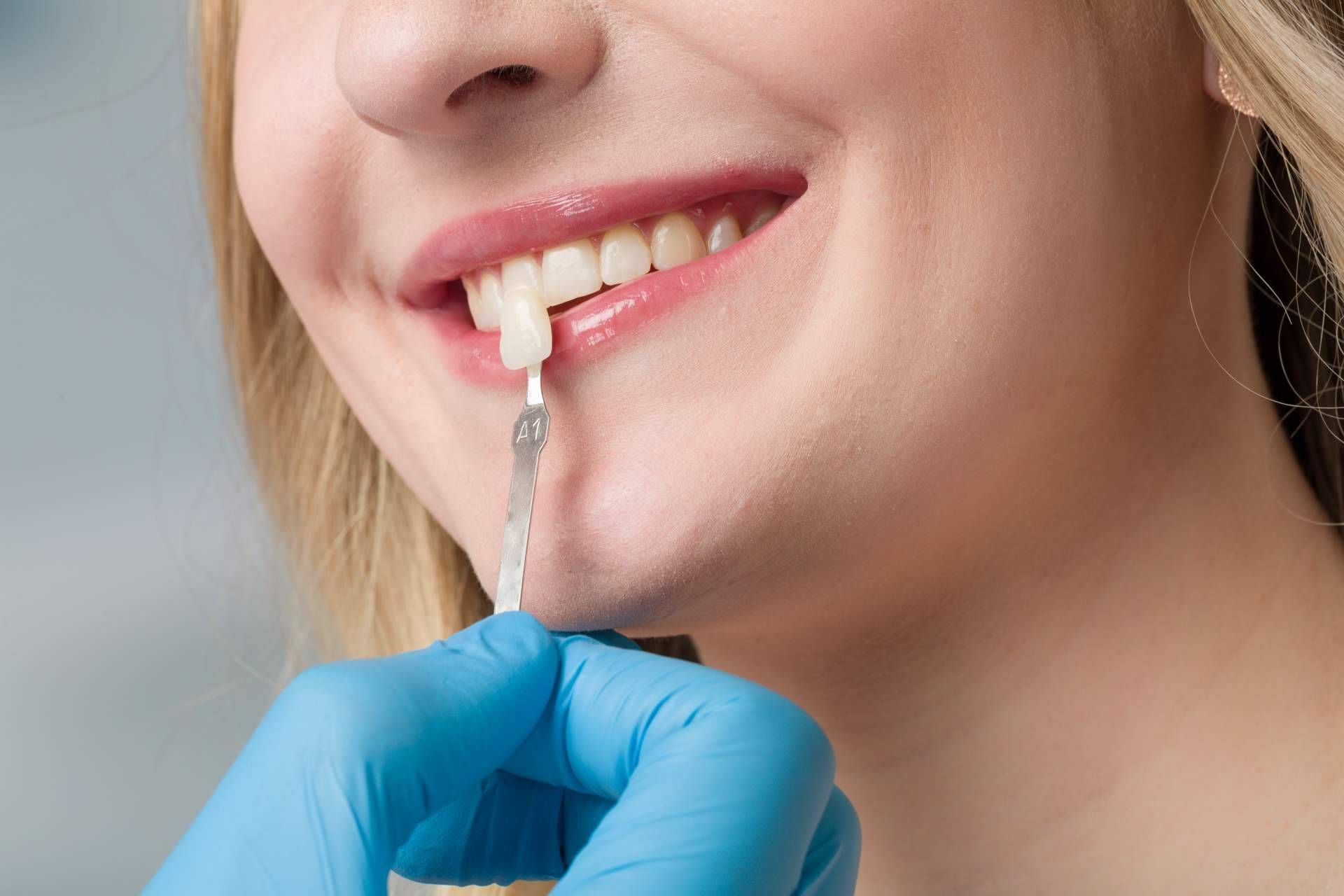 Información sobre el tratamiento de carillas dentales de esta clínica dental de Chamartín