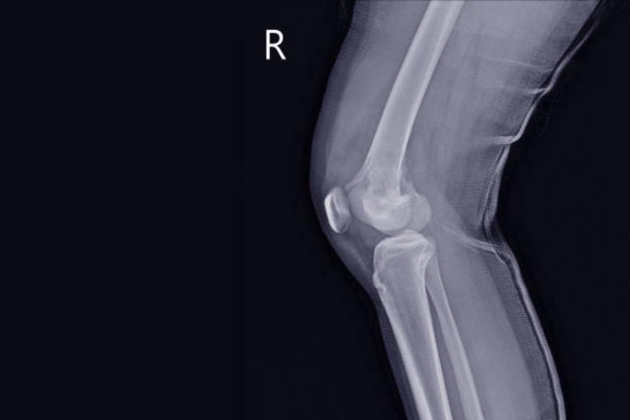 Sarcoma de tejido óseo y blando