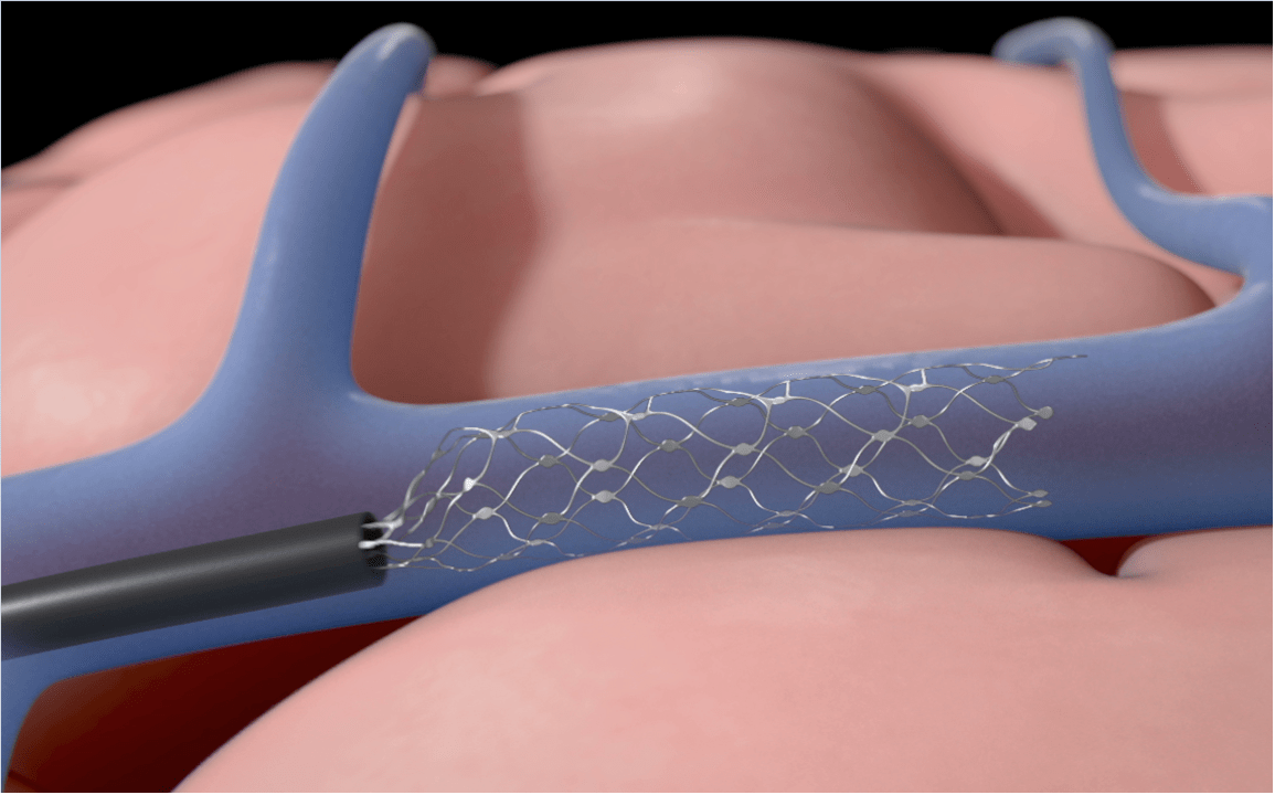 Synchron, la startup que ha destronado a Elon Musk en la carrera por el control mental 1 Merca2.es synchron stentrode Merca2.es