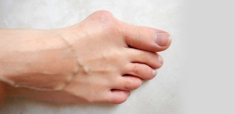 Los problemas de salud por llevar tacones que no conocías 47 Merca2.es Juanetes