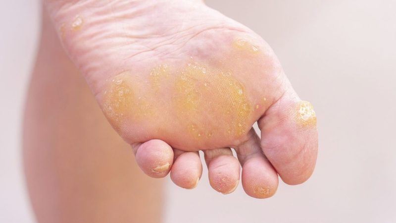 Los problemas de salud por llevar tacones que no conocías 48 Merca2.es Callos