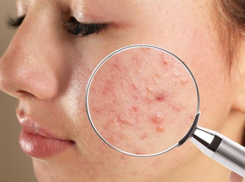 acne acne