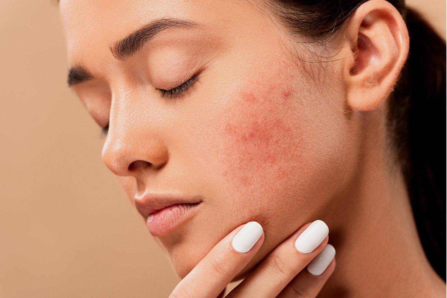 Cómo tratar el acné de manera natural 1 Merca2.es acne