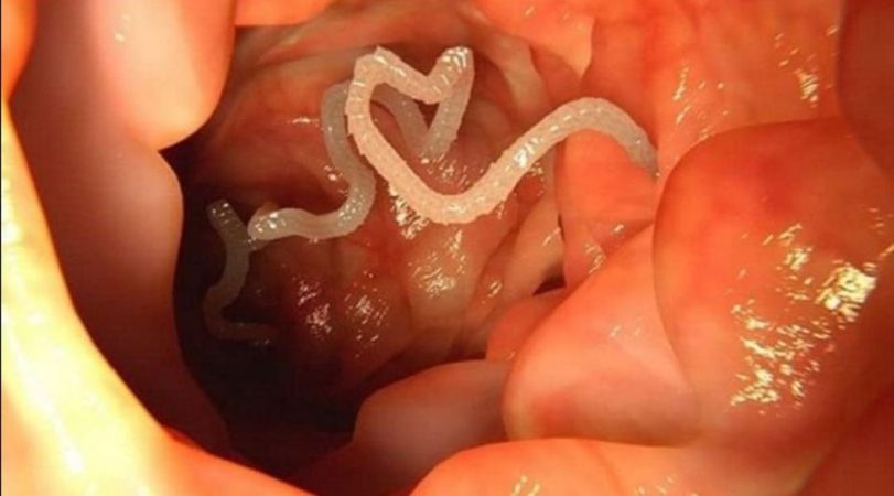 Las dietas más extrañas del mundo que te pueden dañar tu organismo gravemente 40 Merca2.es Ingerir una tenia