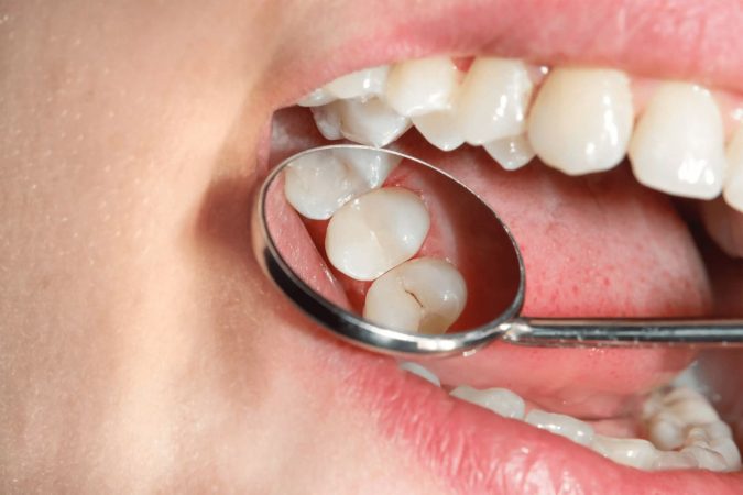Búsqueda de caries en dientes