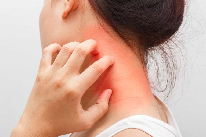 Dermatitis atopica Merca2.es