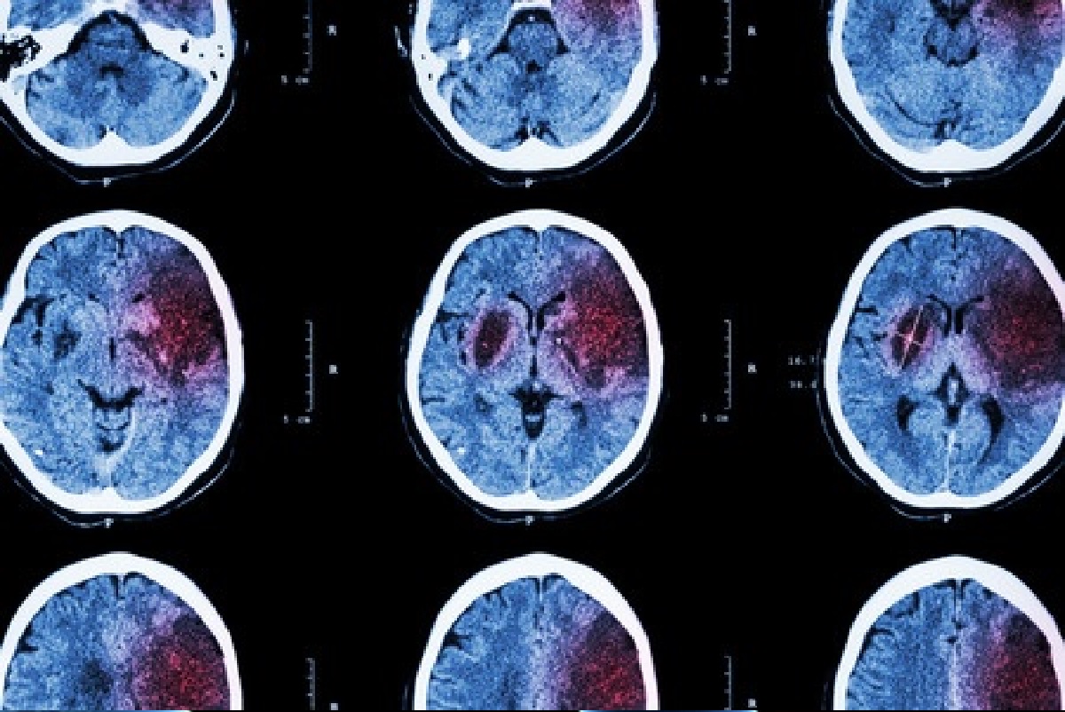 La prevención es cada vez más viable, y eficaz, en la enfermedad cerebrovascular