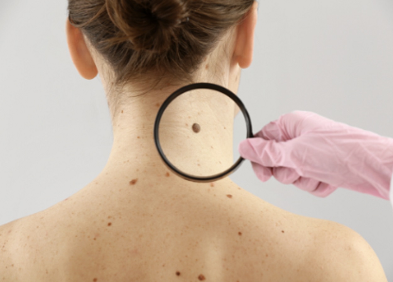 ¿Se curará el cáncer de piel sin cirugía?