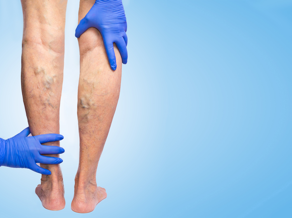 Las varices afectan a 6 de cada 10 mujeres a lo largo de sus vidas y se pueden tratar sin cirugía