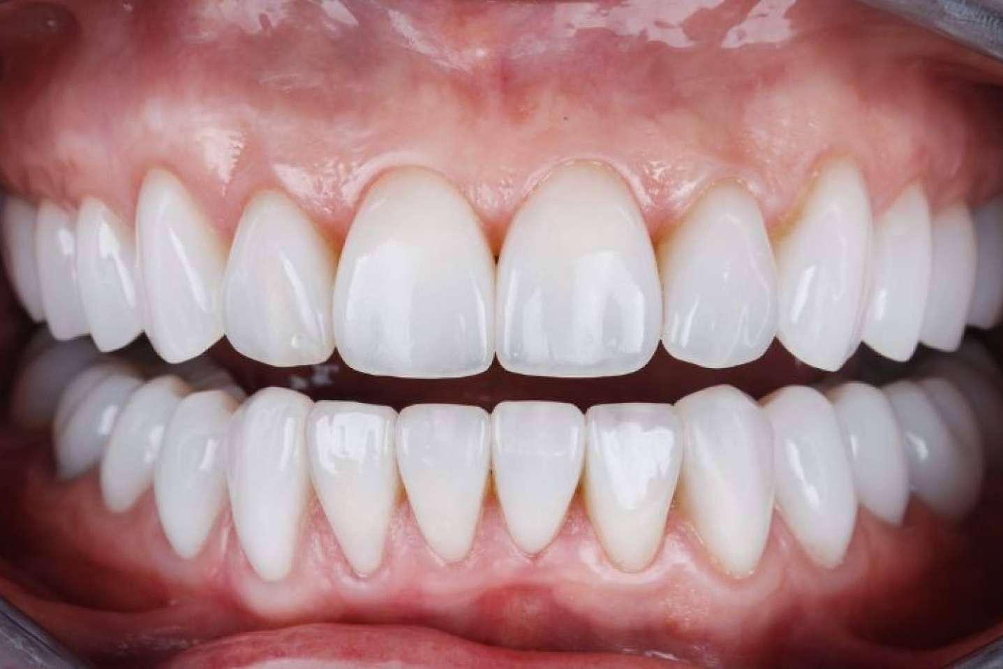 Clínica Dental Ruiz de Gopegui explica los beneficios de las carillas de composite