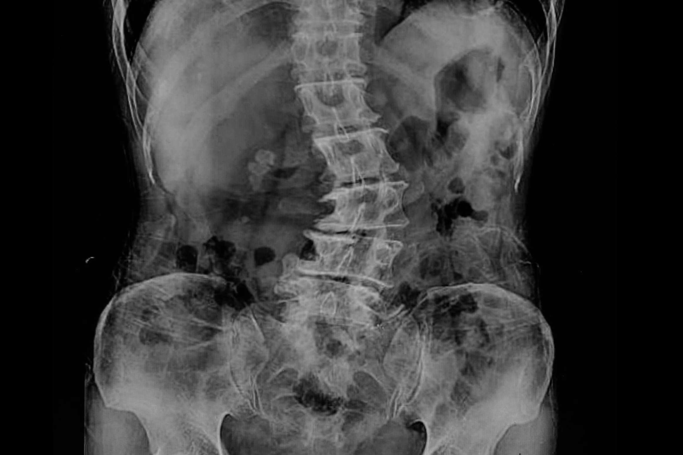 La escoliosis lumbar y sus principales causas y tratamientos
