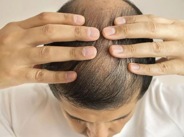 ¿La genética importa a la hora de prevenir la calvicie?