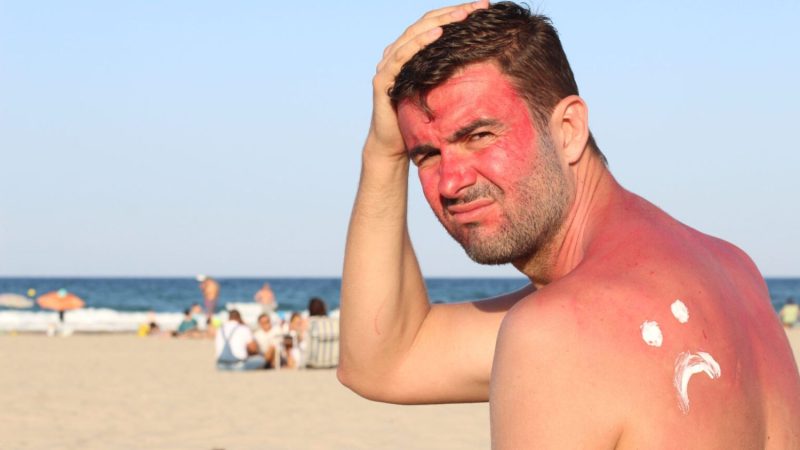 Hombre con quemaduras solares