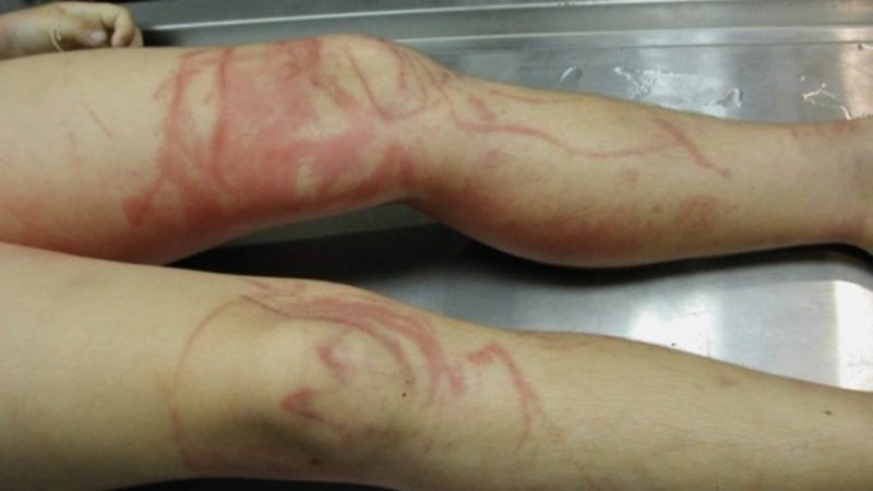 Estos son los animales y microorganismos que te pueden picar cuando te bañas en la playa 45 Merca2.es picadur Merca2.es