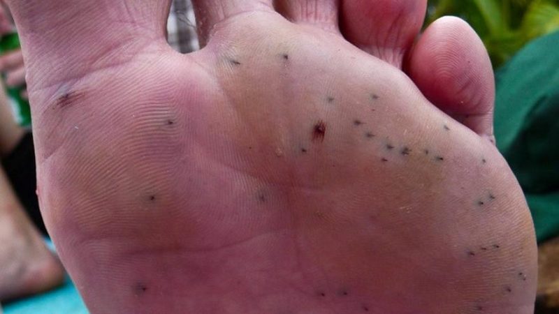 Estos son los animales y microorganismos que te pueden picar cuando te bañas en la playa 46 Merca2.es picaduras pie Merca2.es