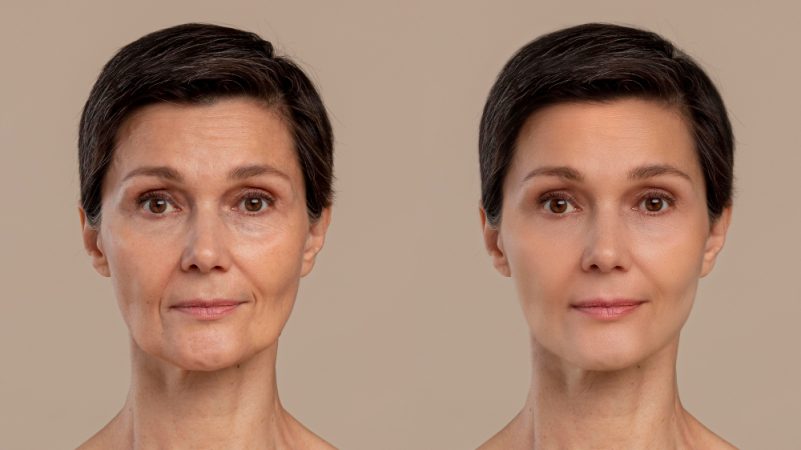 Contouring facial