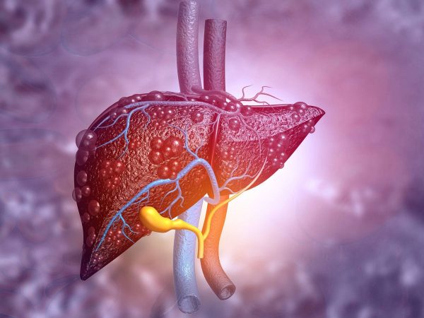 Lo que debes evitar para no tener hígado graso