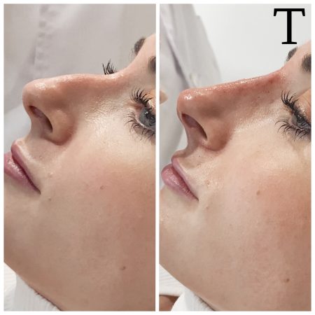 Rinomodelación cirugía plástica clínica Trevi 