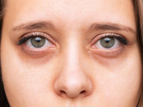 Las ojeras son consideradas por muchos como un problema estético