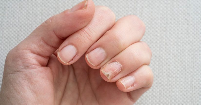 ¿Cuántas clases de rayas en las uñas hay?