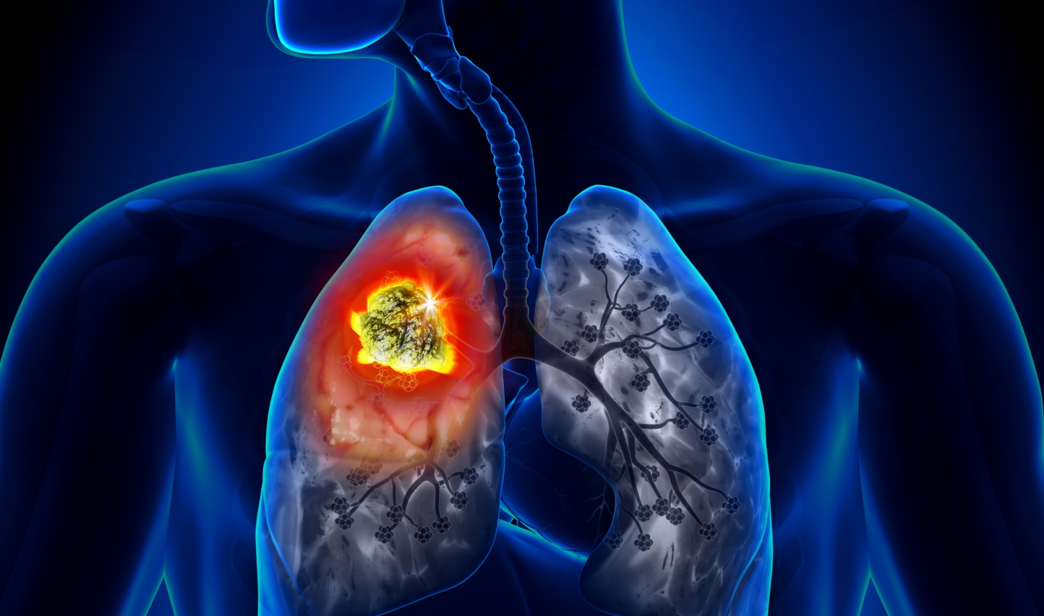 Beneficios de la medicina tradicional para el cáncer de pulmón