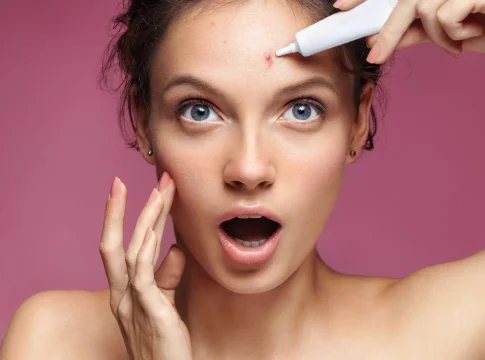 Acné, trucos que si funcionan Acné, trucos que si funcionan