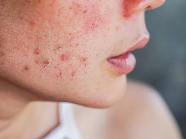 acne Merca2
