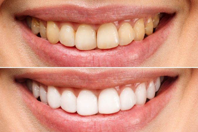 dientes Merca2