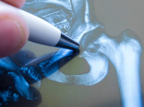 fracturas de cadera osteoporóticas fracturas de cadera osteoporóticas