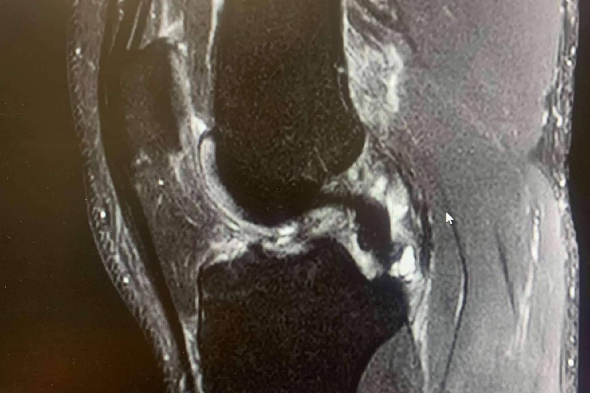 La prevención de las lesiones de ligamento cruzado anterior, por Regeneractiva