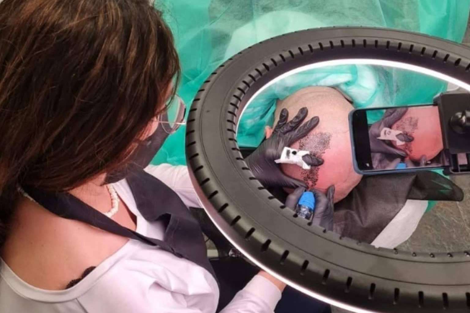 Dermopigmentación Clínica, especialistas en micropigmentación capilar en mujeres