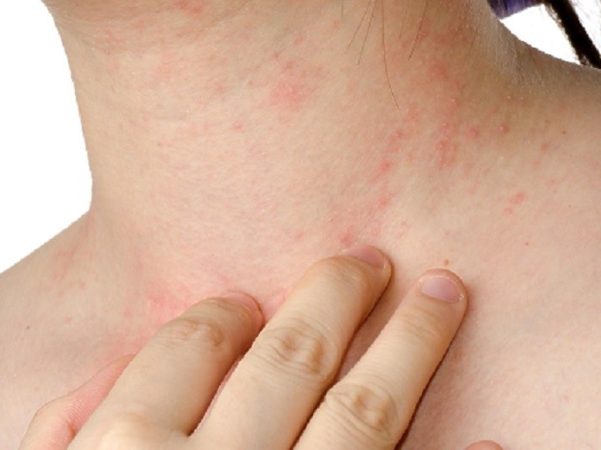 Alergias cutaneas Merca2