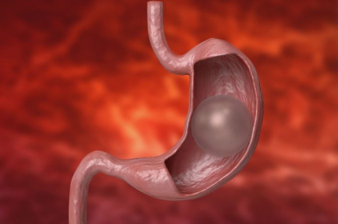 ¿Qué es el balón intragástrico y cuándo es idóneo usarlo? 1 Merca2.es Balon gastrico Merca2.es