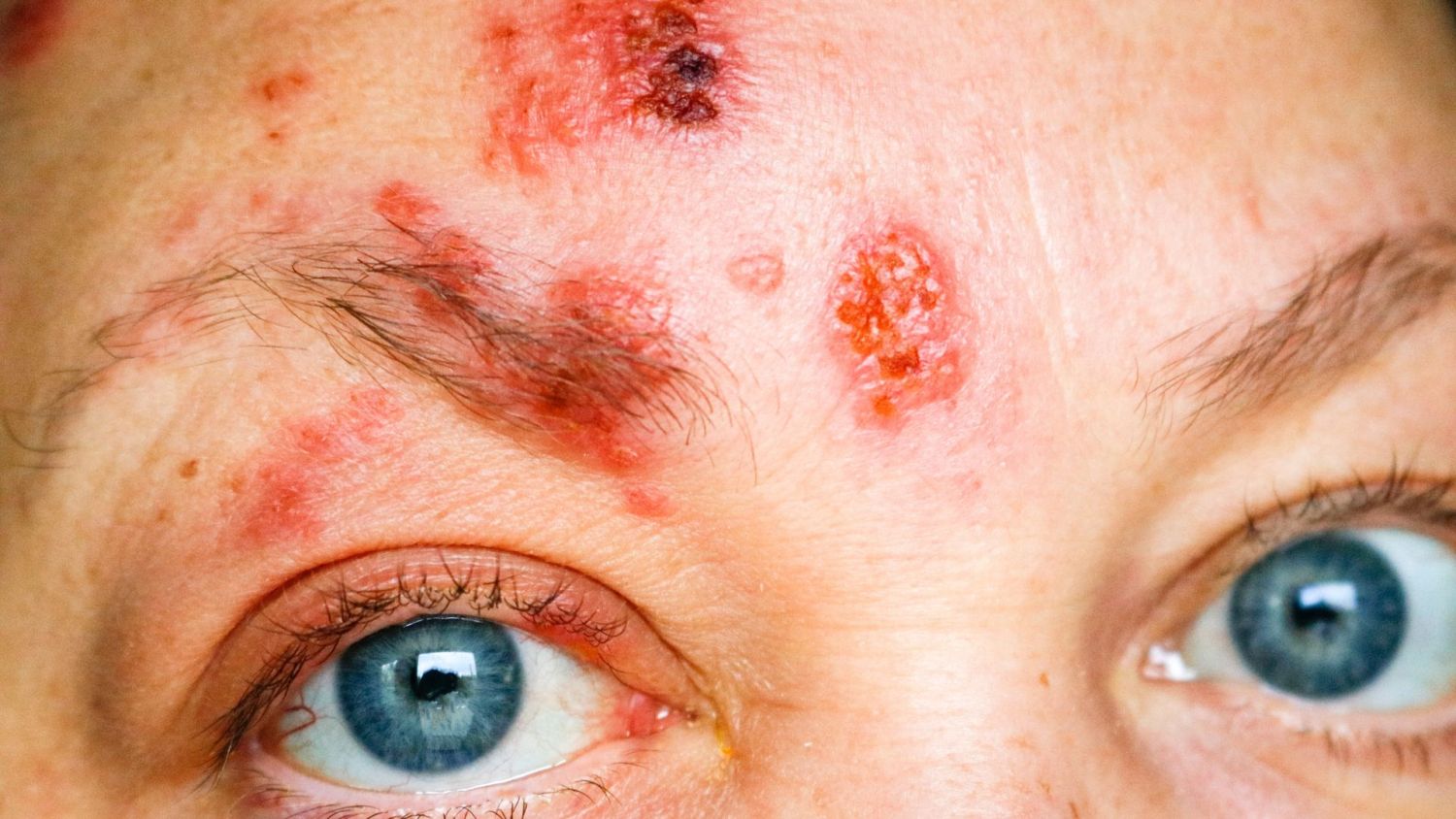 ¿Por qué no sale el herpes zóster? Así podemos tratar esta grave enfermedad 4 Merca2.es ALIMENTACIÓN Y STESS: ESPIRAS EN EL CAMINO