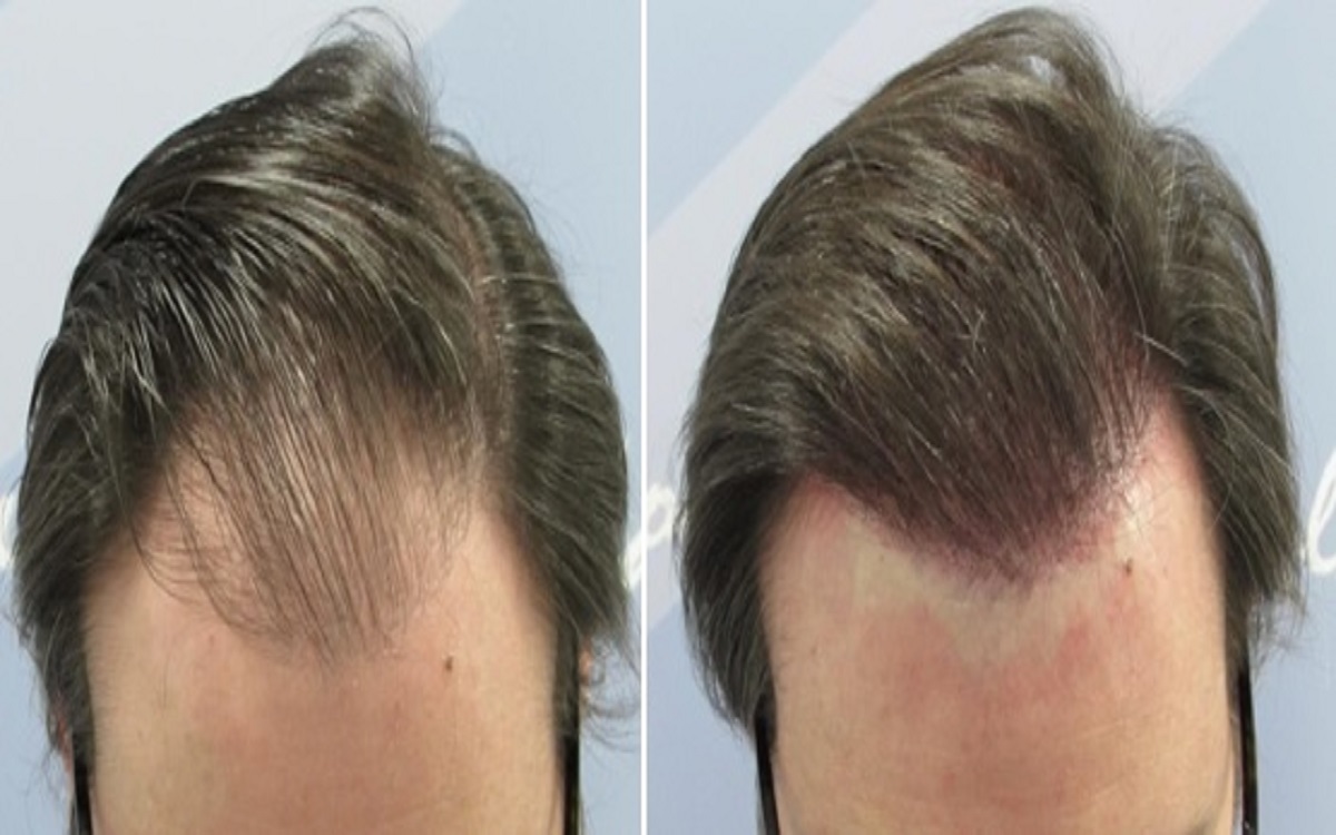 implante de pelo implante de pelo