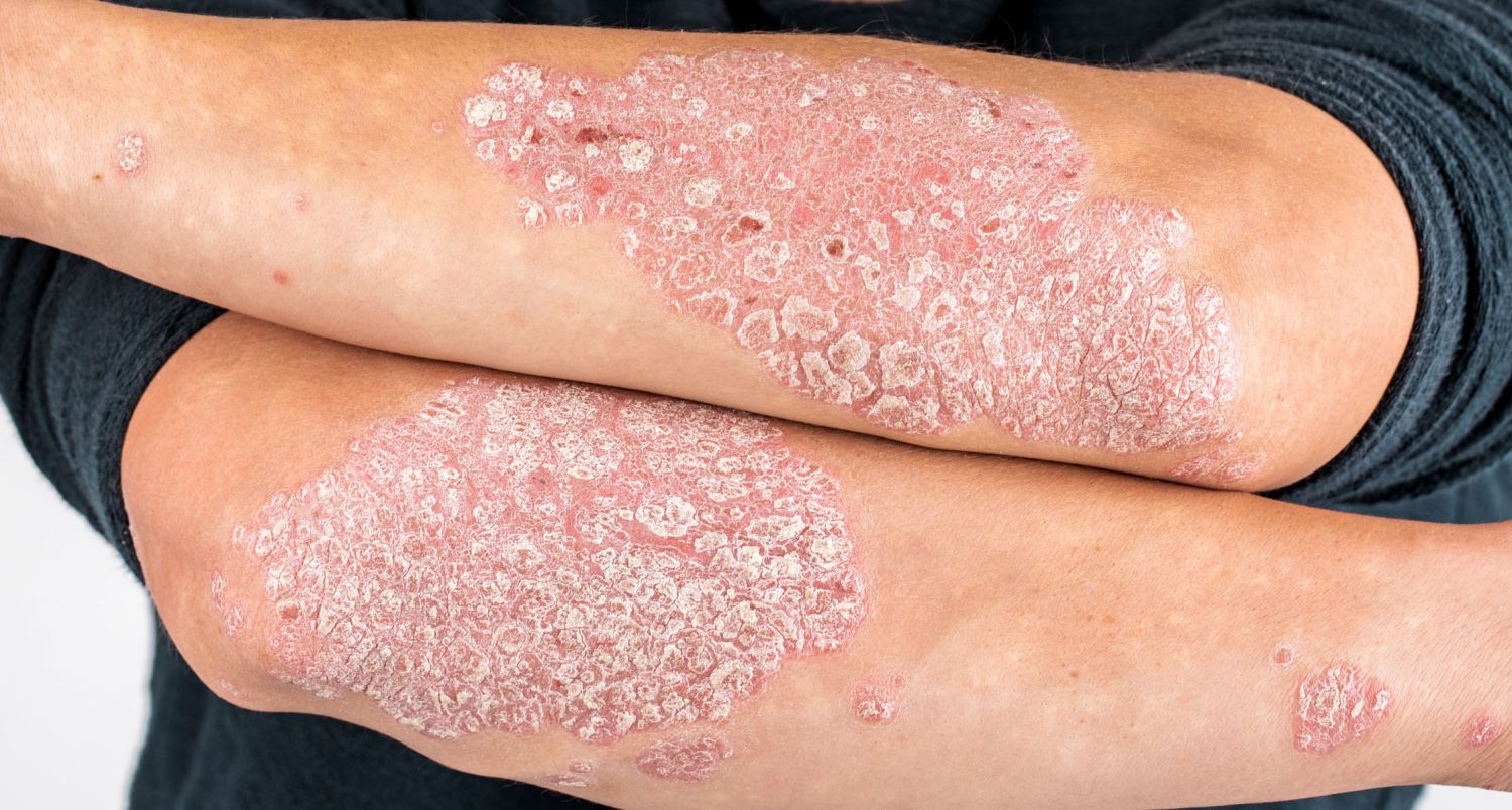 Cómo saber si tienes psoriasis y cómo tratarla