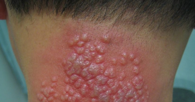 Herpes zóster: cómo identificarlo y cómo tratarlo 1 Merca2.es ¿QUÉ ES EL HERPES ZÓSTER?