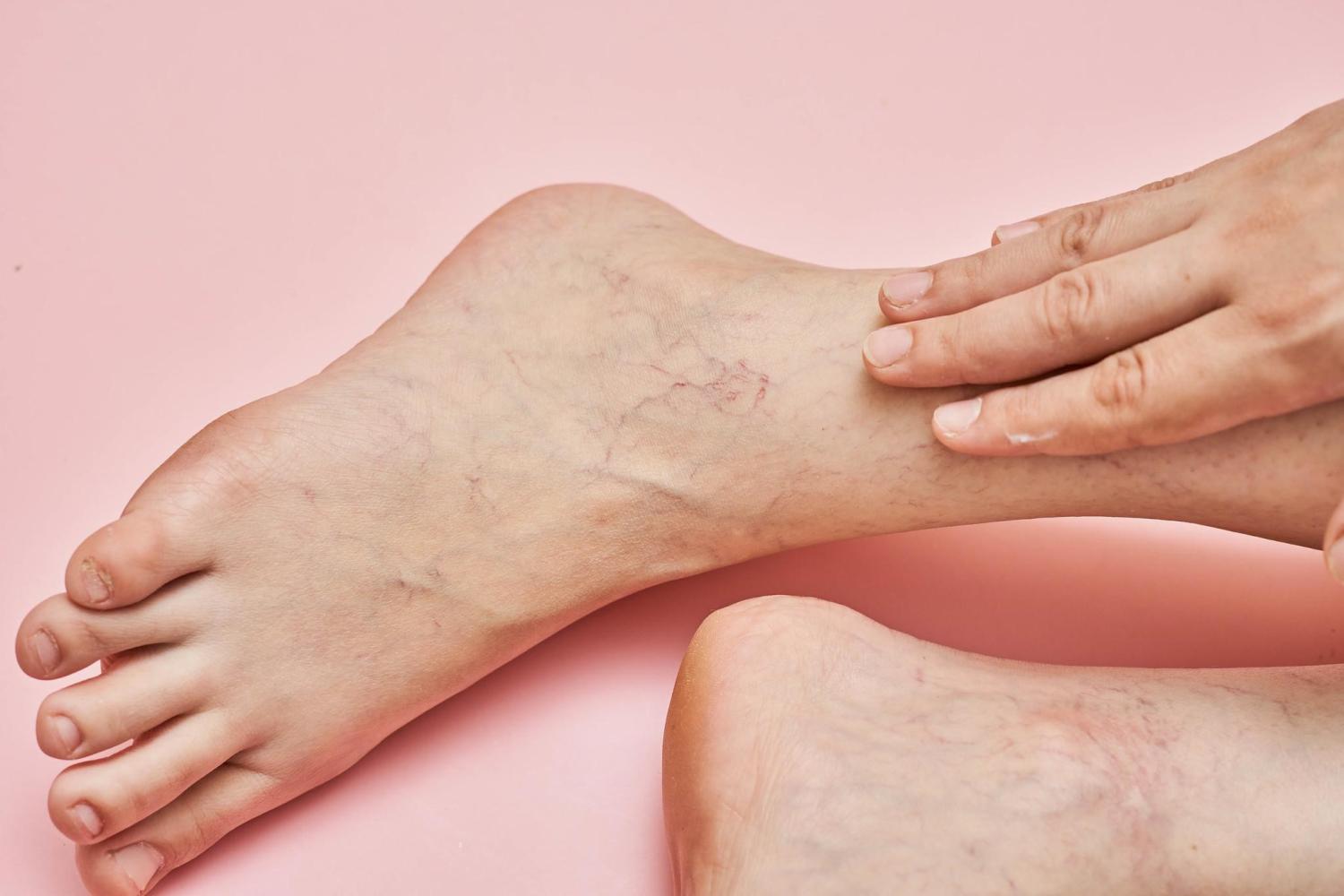 Tratamiento de várices: avances y soluciones caseras que deberías probar 3 Merca2.es IMPACTO PSICOLÓGICO Y CALIDAD DE VIDA