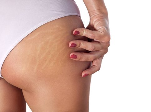 combatir-estrias Di adiós a las estrías con este ungüento viral, fácil de hacer y con solo 2 ingredientes