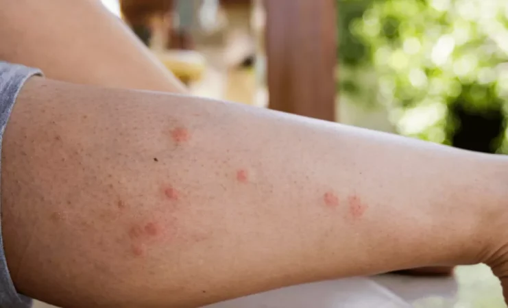 Plaga de mosquito tigre: trucos para evitar su dolorosa picadura 27 Merca2.es pierna Merca2.es