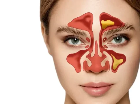 remedio-decir-adios-sinusitis Remedio casero infalible para decir adiós a la sinusitis crónica