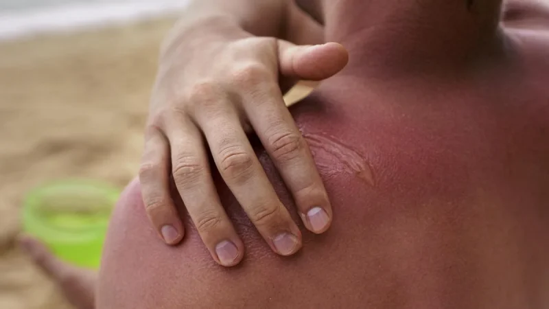 Identificar la gravedad de la quemadura si te has quemado la piel