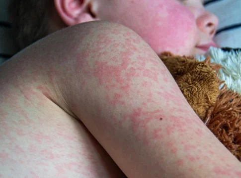 virus-de-la-bofetada-quees