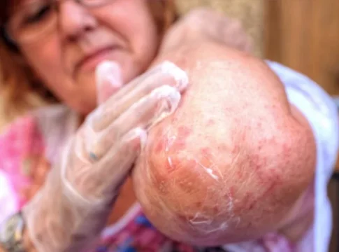 tienes-estos-sintomas-en-la-piel Si tienes 3 de estos 5 síntomas en la piel, es crucial que acudas al médico