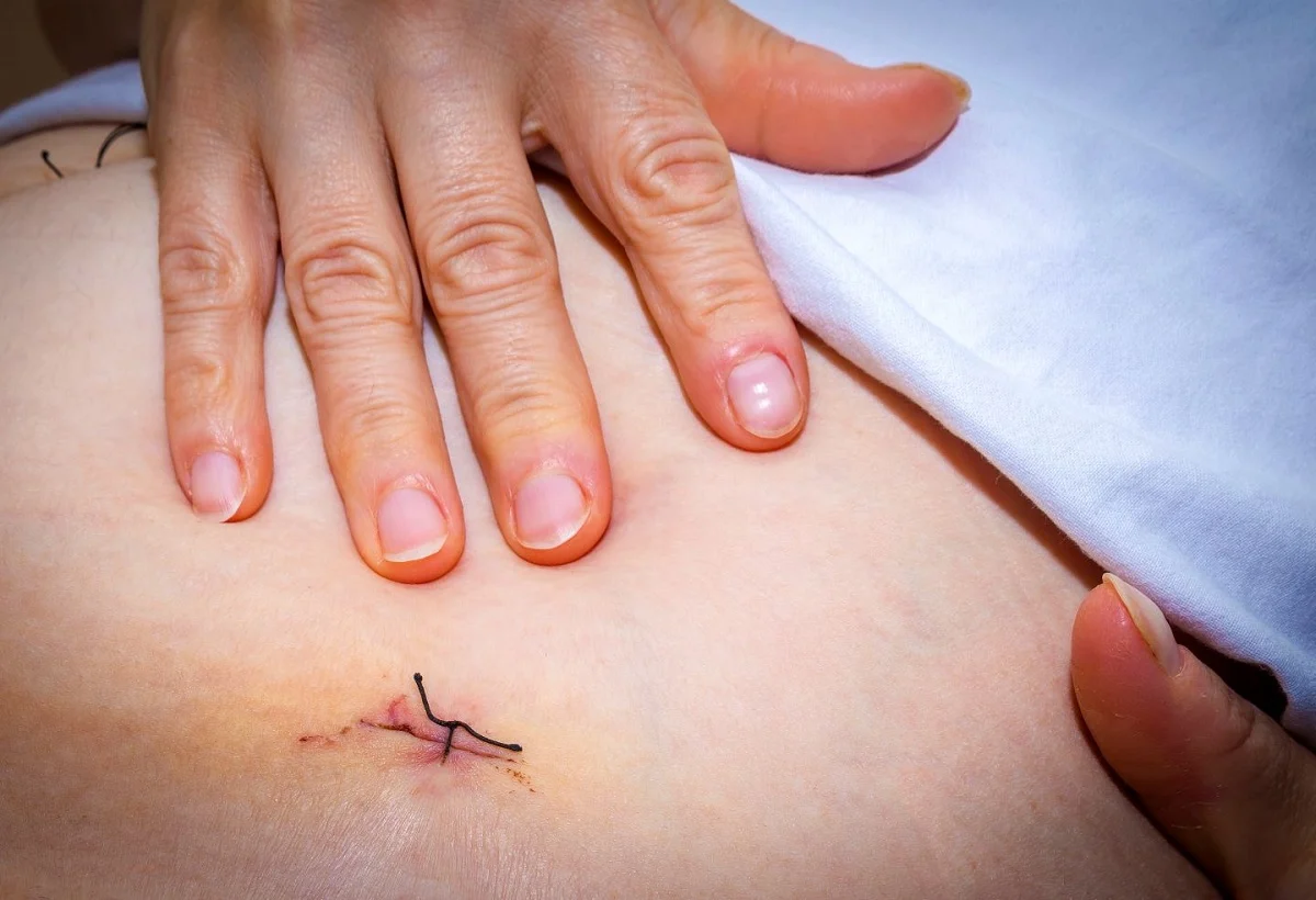 Los avances en la cirugía de la endometriosis profunda reducen las complicaciones y mejoran el resultado y la seguridad